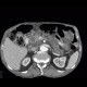 Intrapapillary mucinous neoplasm of pancreas, IPMN, central IPMN: CT - Computed tomography